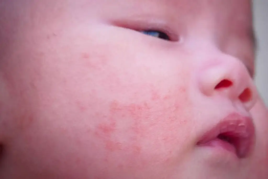 Baby Acne Causes Treatments and Tips